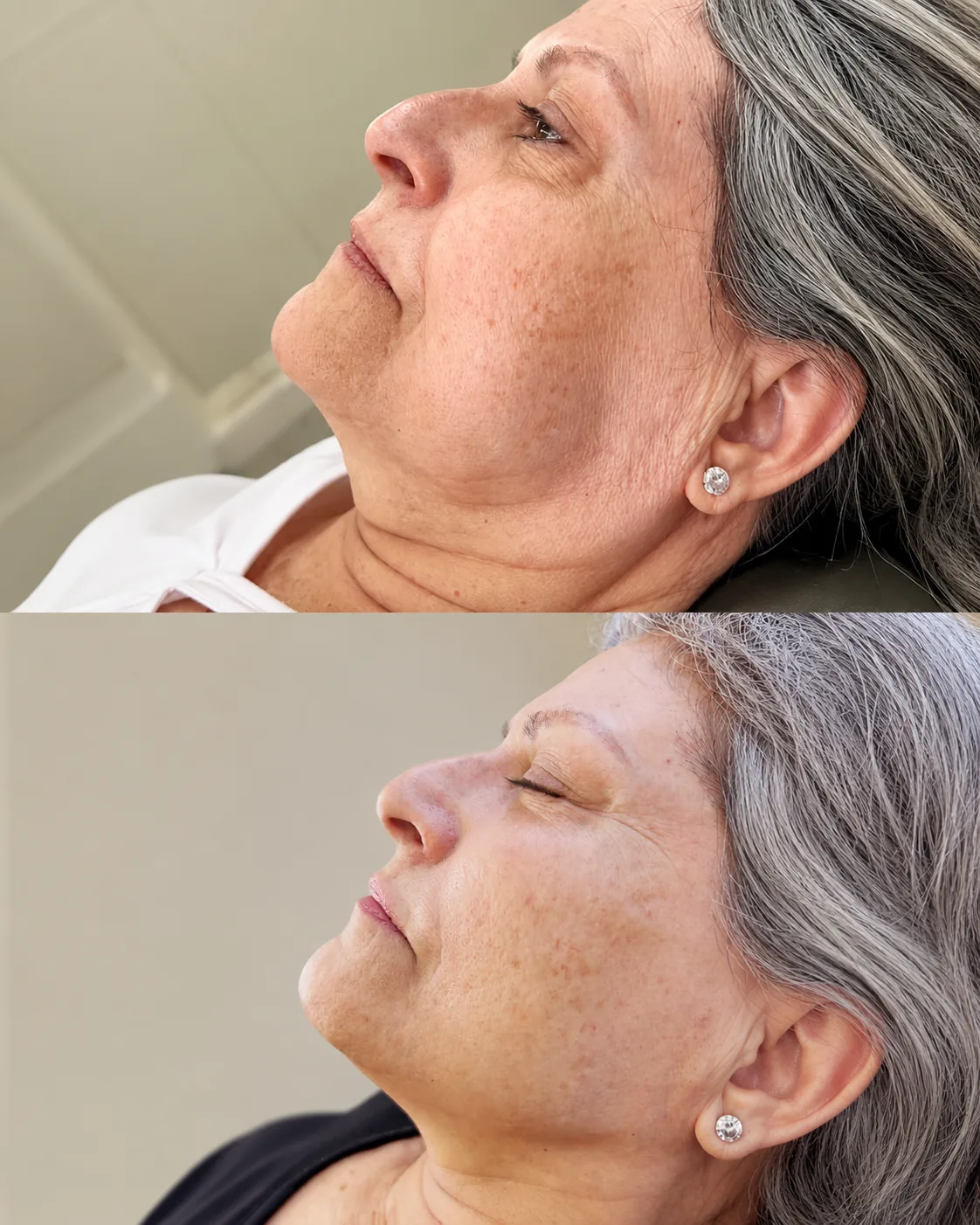 Harmonização Facial